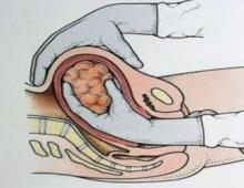 Положение плаценты по отношению к внутреннему зеву Место прикрепления плаценты к матке
